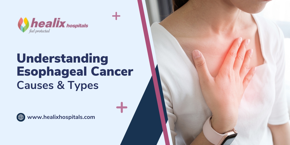 Understanding Esophageal Cancer: Causes and Types